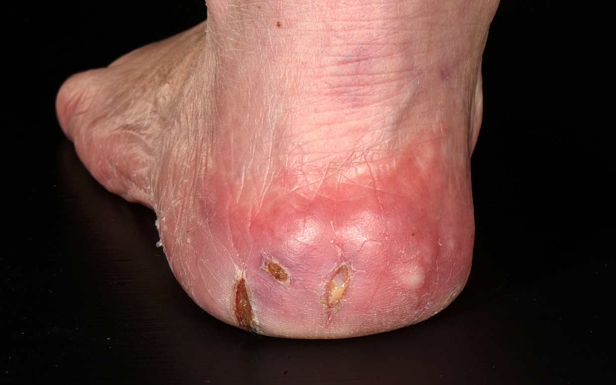 a image of heel cracks or a potential foot ulcers or sore, after knock - Legs Matter