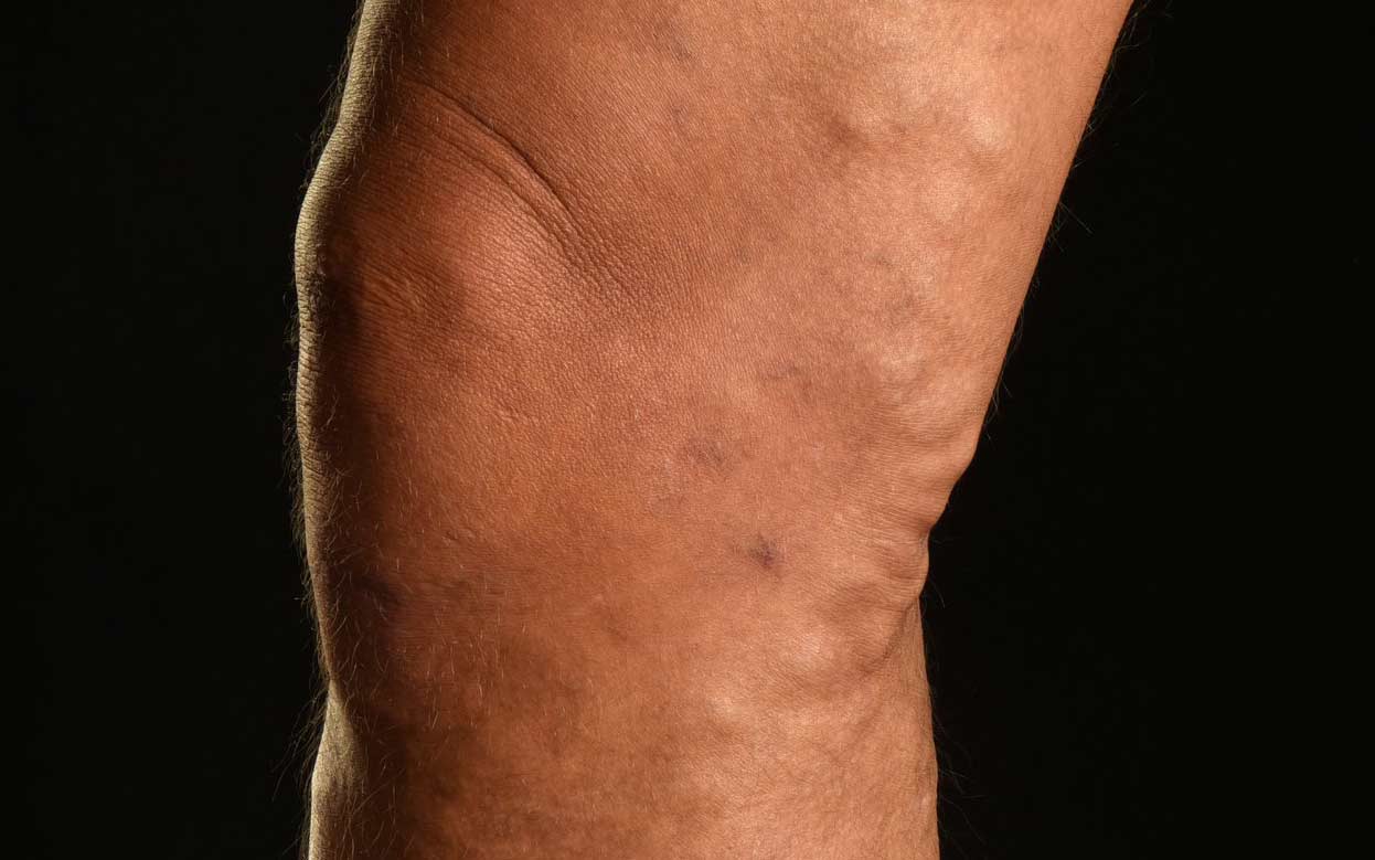 An image of varicose veins around a person's knee - Legs Matter