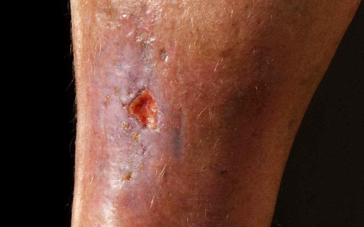a image of venous leg ulcers or sore, after knock - Legs Matter