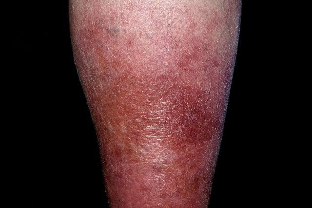 Image showing cellulitis symptoms on the leg