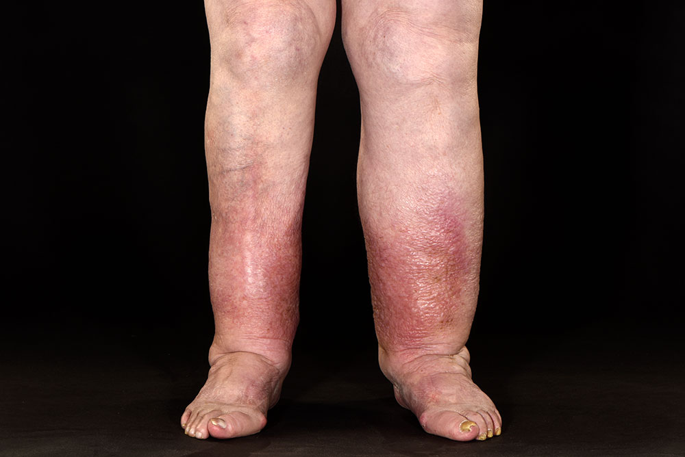 and image of chronic oedema
