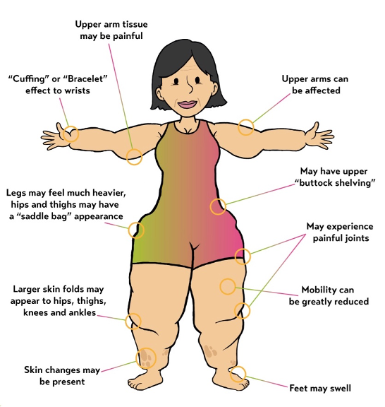 Lipoedema diagram