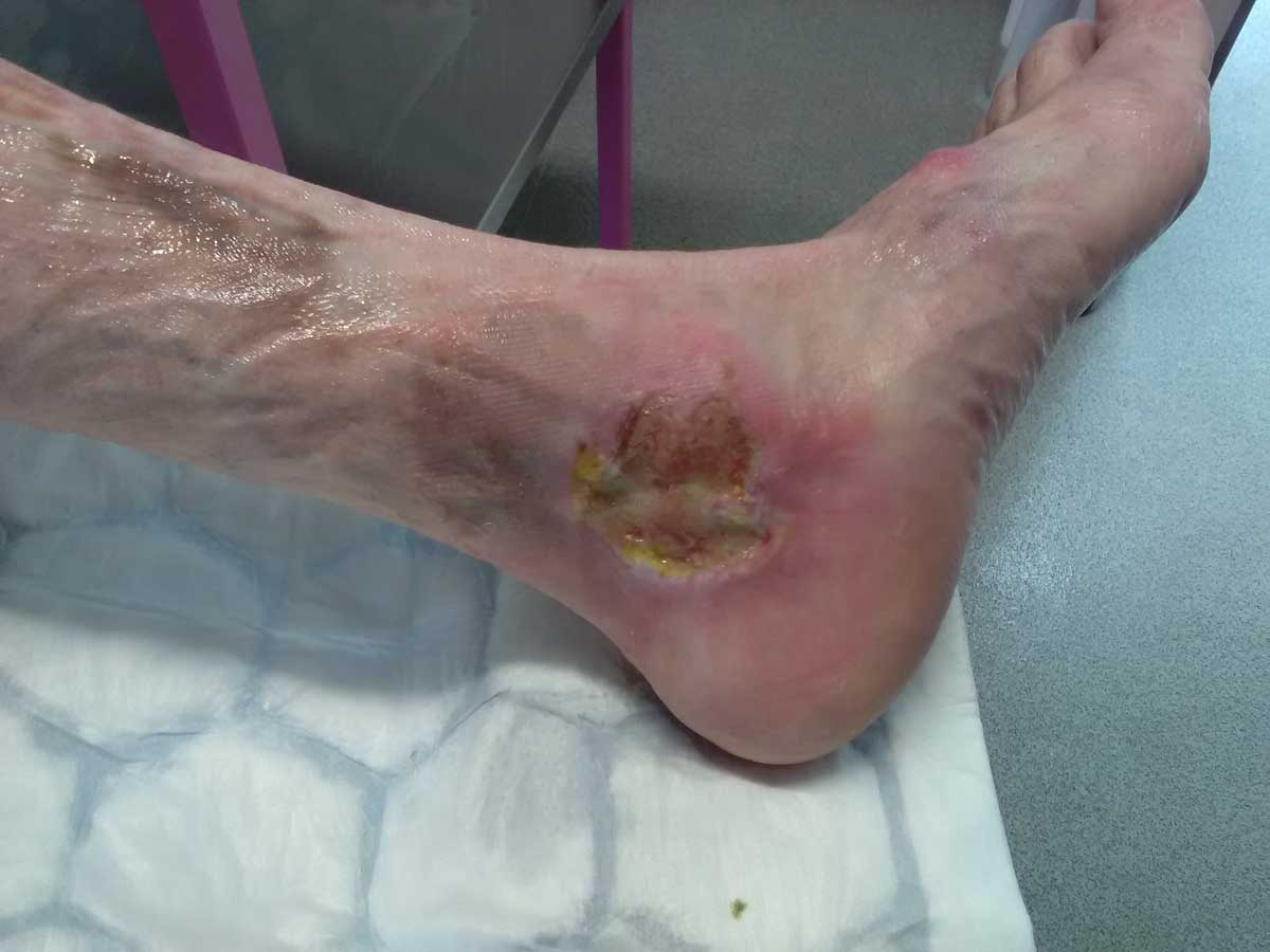 What does Pyoderma Gangrenosum looks like? And image of Pyoderma Gangrenosum on a leg