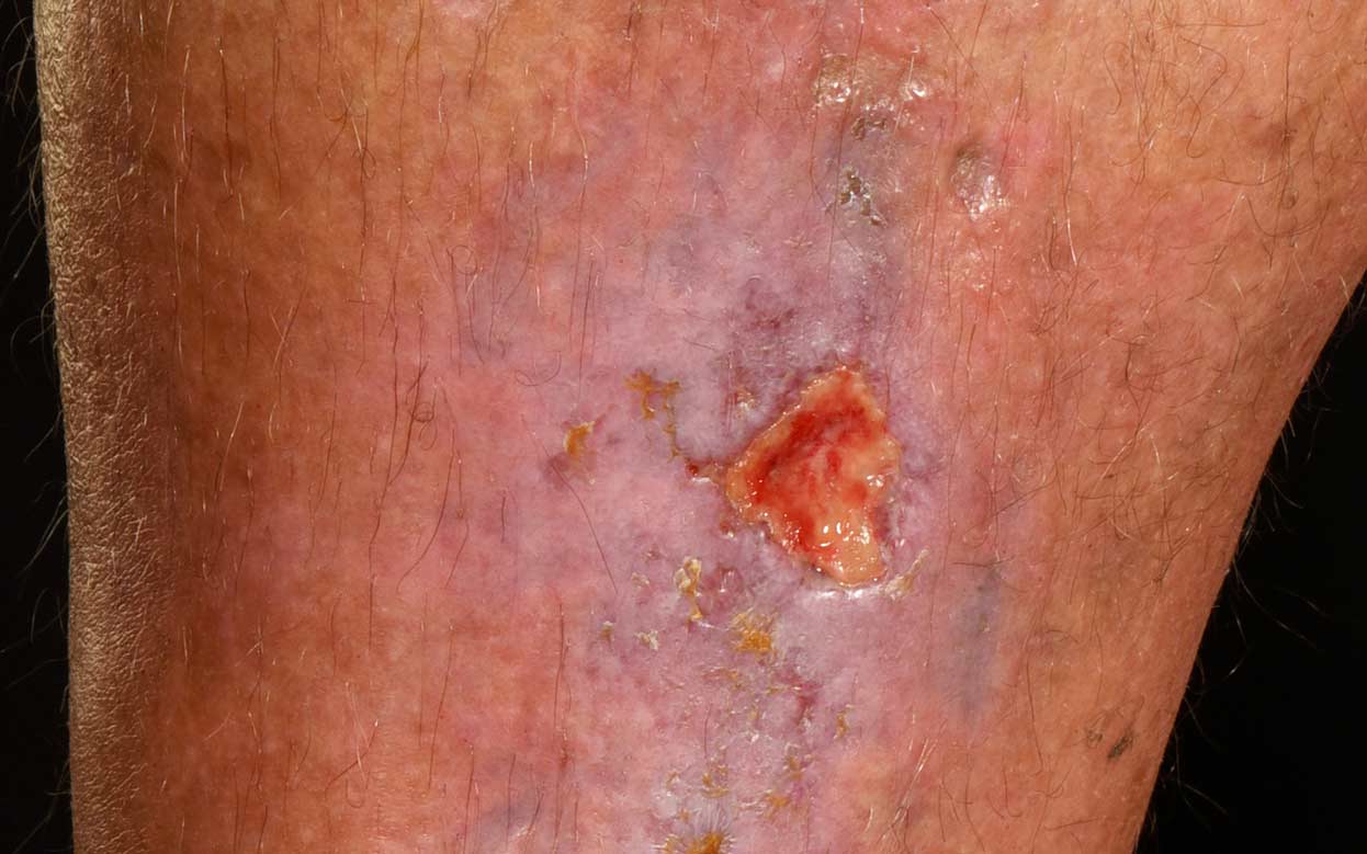 skin-ulcer-leg