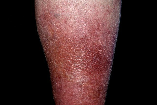 Image of Cellulitis on the leg for Legs Matter