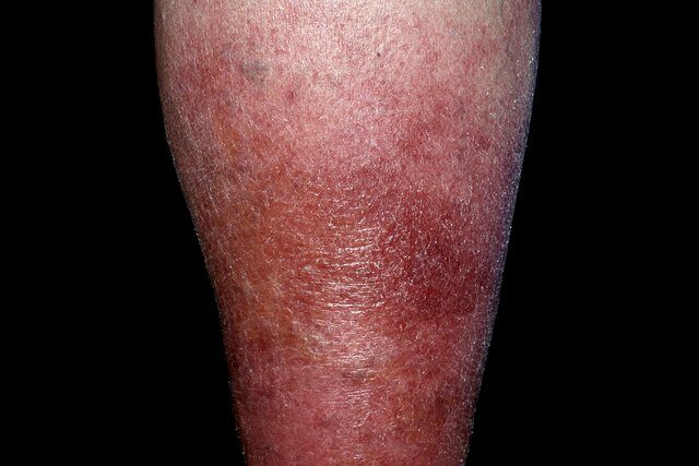 red-leg-rash-causes