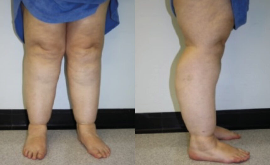 Causes, Symptoms & Treatment of Lipoedema