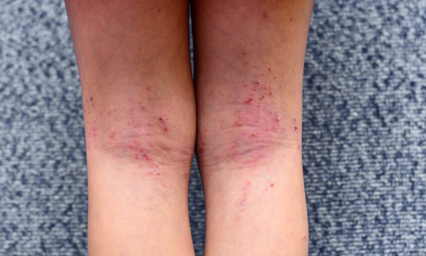 Dry cracked skin on on sale legs