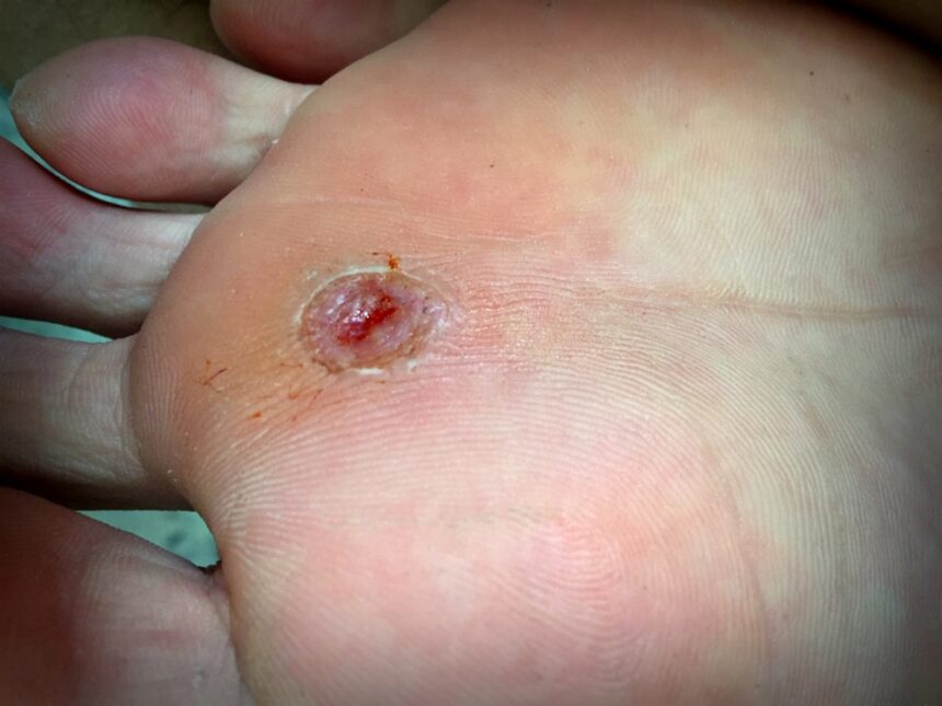Non diabetes related foot ulcer